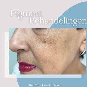 Huidzorg Laserklinieken Eindhoven- Best image 5