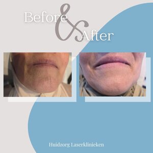 Huidzorg Laserklinieken Eindhoven- Best image 6