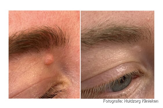 Cosmetisch storende moedervlek? Dermatologische shave-excisie nu ook mogelijk in Den Bosch